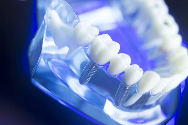 Modello di carie dentale — Foto Stock