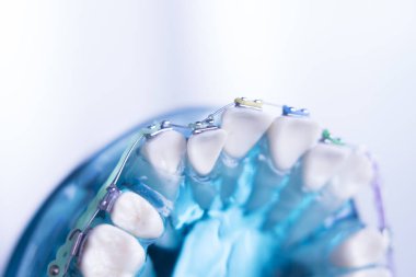 Diş diş köşeli metal