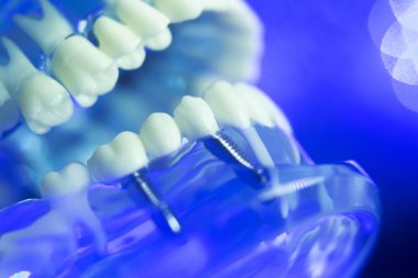 Diş hizalama diş modeli