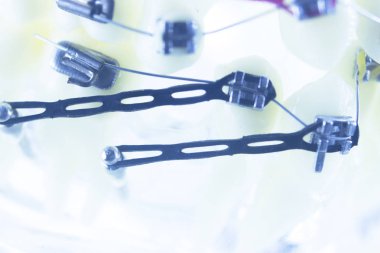 Diş diş parantez aligners