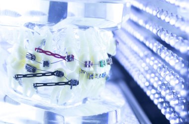 Diş diş parantez aligners