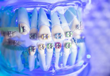 Diş diş köşeli metal