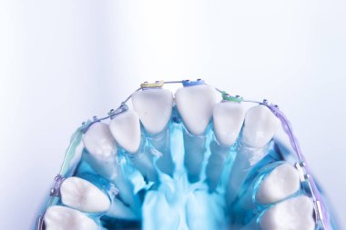 Diş diş köşeli metal