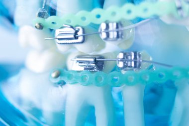 Diş diş köşeli metal