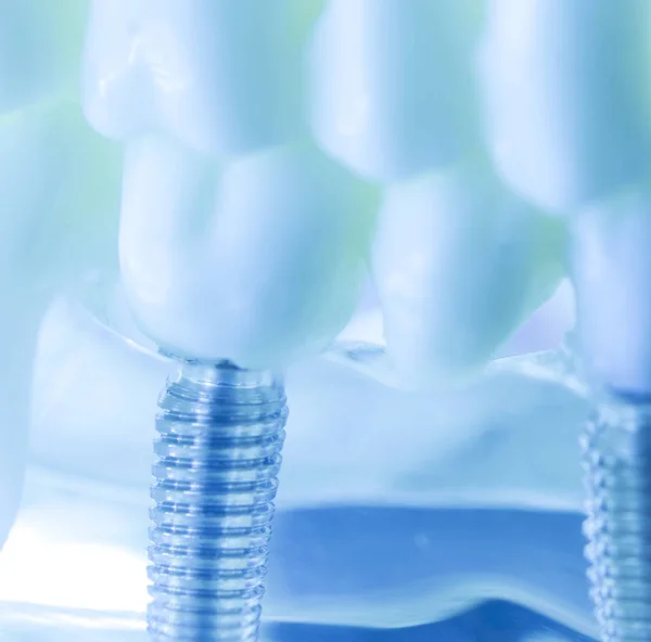 Zębów dentystycznych tytanu implant — Zdjęcie stockowe