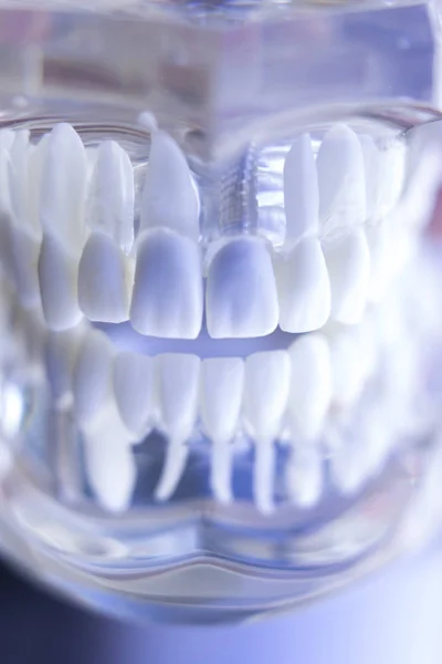 Implante dental dentario —  Fotos de Stock