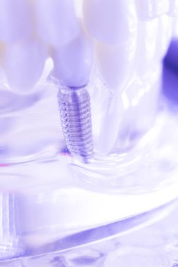 Diş titanyum implant diş