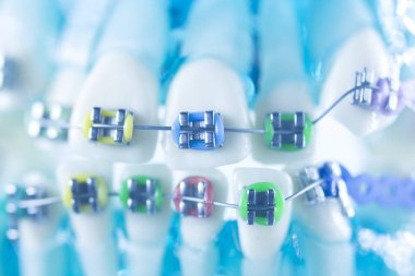 Diş diş köşeli metal