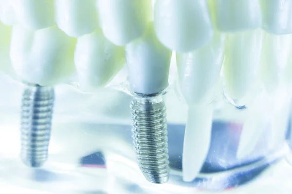 Zębów dentystycznych tytanu implant — Zdjęcie stockowe