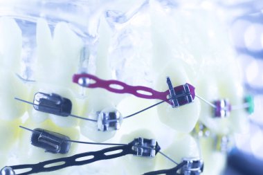 Diş diş parantez aligners