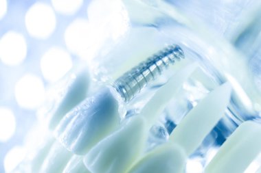 Diş titanyum implant diş