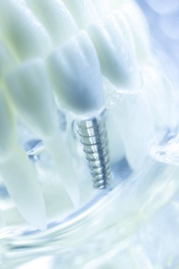 Diş titanyum implant diş