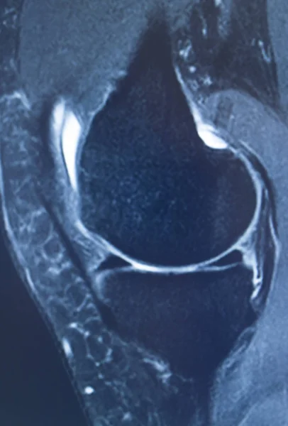 Lesão no joelho mri mcl rasgo — Fotografia de Stock