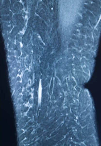 Cedera lutut mri mcl — Stok Foto