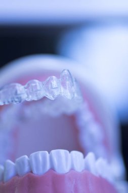 Görünmez diş diş aligners
