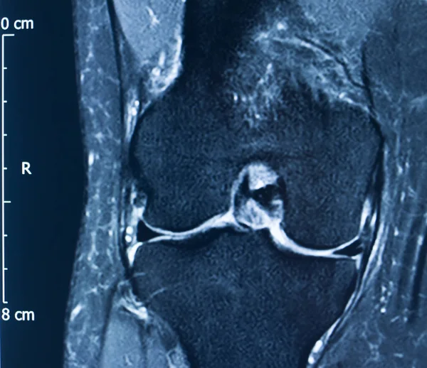 Urazy kolana MRI MCL Tear — Zdjęcie stockowe