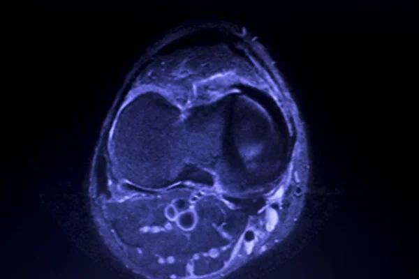 MRI menisku kolana łza skanowania — Zdjęcie stockowe