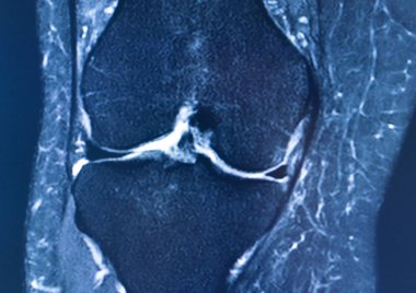 Diz yaralanması MRI MCL gözyaşı