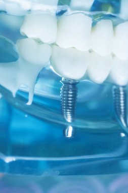 Diş hekimi diş implantı diş modeli