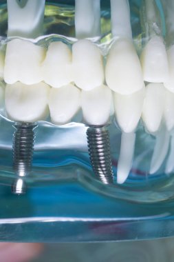 Diş hekimi diş implantı diş modeli