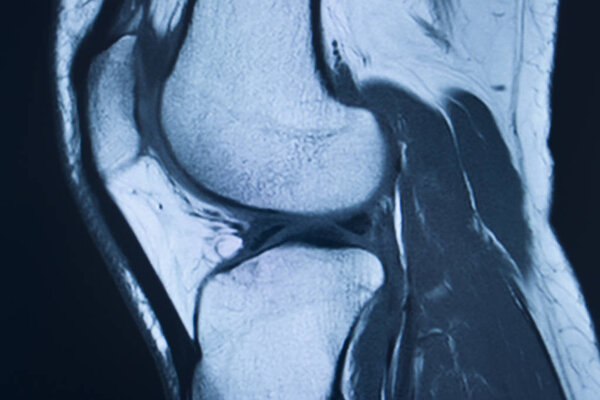 Knee injury mri mcl tear