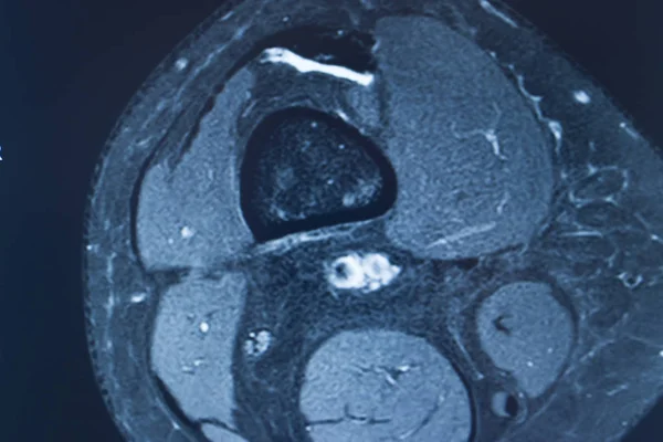 Травма коліна mri mcl сльоза — стокове фото