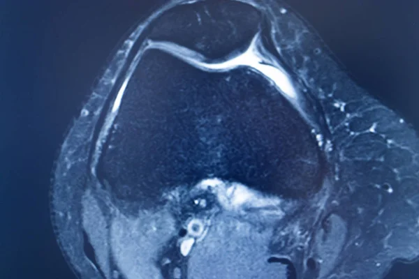 Urazy kolana MRI MCL Tear — Zdjęcie stockowe