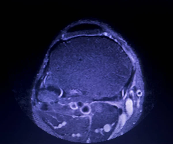 Mri の膝のメニスカスの裂け目スキャン — ストック写真