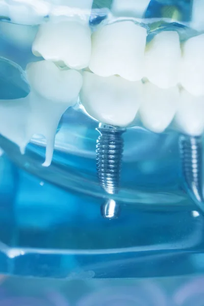 Dentista dientes implantar modelo dental — Foto de Stock
