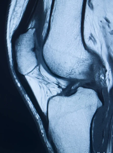 Травма коліна mri mcl сльоза — стокове фото