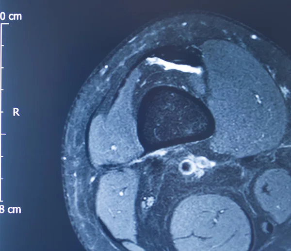 Lesão no joelho mri mcl rasgo — Fotografia de Stock