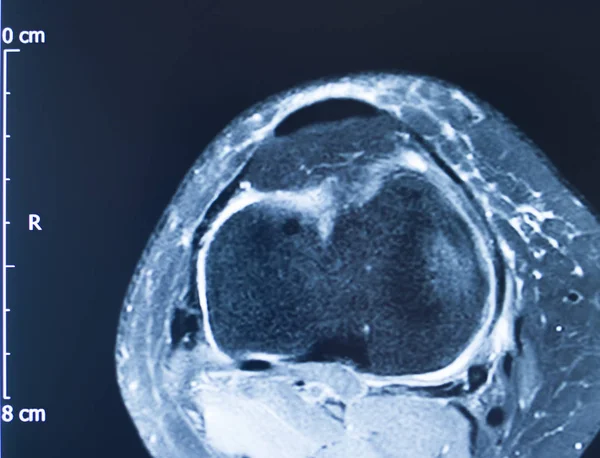 Knee injury mri mcl tear — Stock Photo, Image