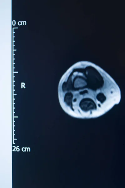 Kneskade MRI-rift – stockfoto