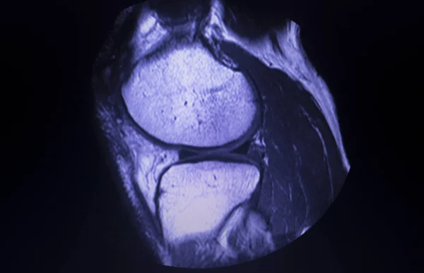 МРТ сканування меню розриву коліна — стокове фото