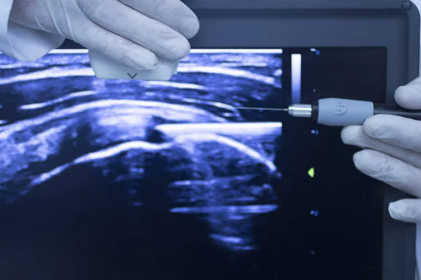EPI dry needling ultrasound scan — Stock Photo, Image