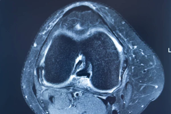 무릎 부상 mri mcl 눈물 — 스톡 사진