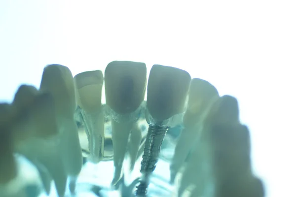 Dental Tooth Teaching Model Showing Prosthetic Teeth Gums — Stock Photo, Image