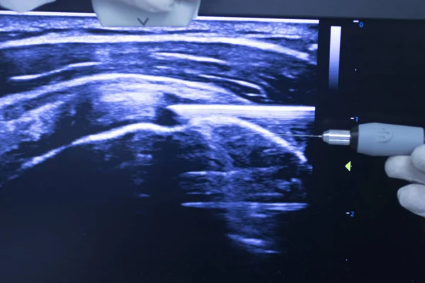 Epi Intratissue Perkutane Elektrolyse Trockennadeln Ultraschalluntersuchung Physiotherapie Medizinische Behandlung — Stockfoto