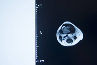 Diz sporu yaralanması MRI derecesi 2 yırtık manyetik rezonans görüntüleme ortopedik travmatoloji taraması.