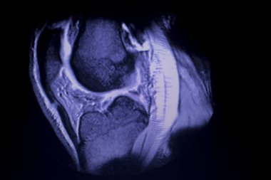 Manyetik rezonans görüntüleme MRG diz arka boynuz medial menisküs gözyaşı scantest sonuçları.