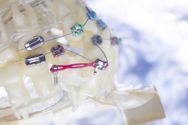 Modern metal tutucular ve plastik algners tel diş braketleri diş düzleştiriciler.