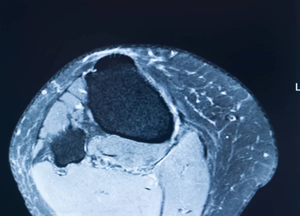 Lesões Esportivas Joelho Mri Mcl Grau Ressonância Magnética Rasgo Traumatologia — Fotografia de Stock