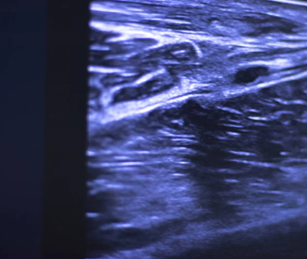 Epi Intratissue Перкутанный Электролиз Сухого Иглоукалывания Экография Сканирования Физиотерапии Медицинское — стоковое фото