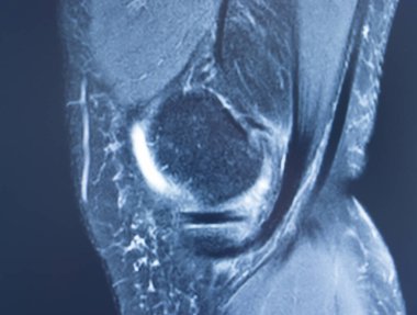 Diz sporu yaralanması MRI derecesi 2 yırtık manyetik rezonans görüntüleme ortopedik travmatoloji taraması.