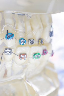 Modern metal tutucular ve plastik algners tel diş braketleri diş düzleştiriciler.