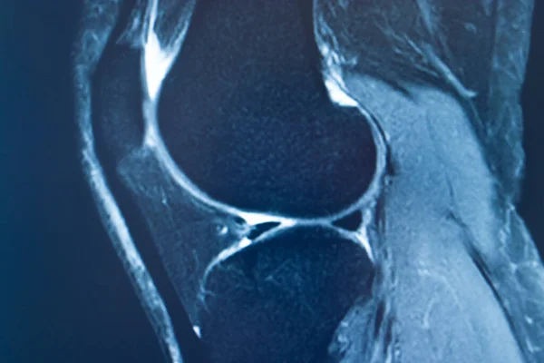 Koleno Sportovní Zranění Mri Mcl Stupeň Trhlina Magnetická Rezonance Ortopedické — Stock fotografie