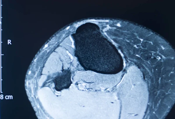 Knee Sports Injury Mri Mcl Grade Tear Magnetic Resonance Imaging — Stock Photo, Image