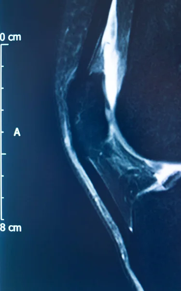 膝スポーツ傷害Mri Mclグレード2涙磁気共鳴画像整形外科外傷スキャン — ストック写真