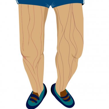 Koşucu bacaklarda varis.