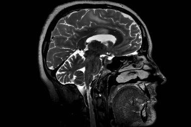 İnsan beyninin hesaplanan rezonans görüntüleme.